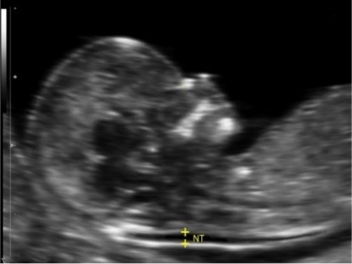 ultrasound fetus